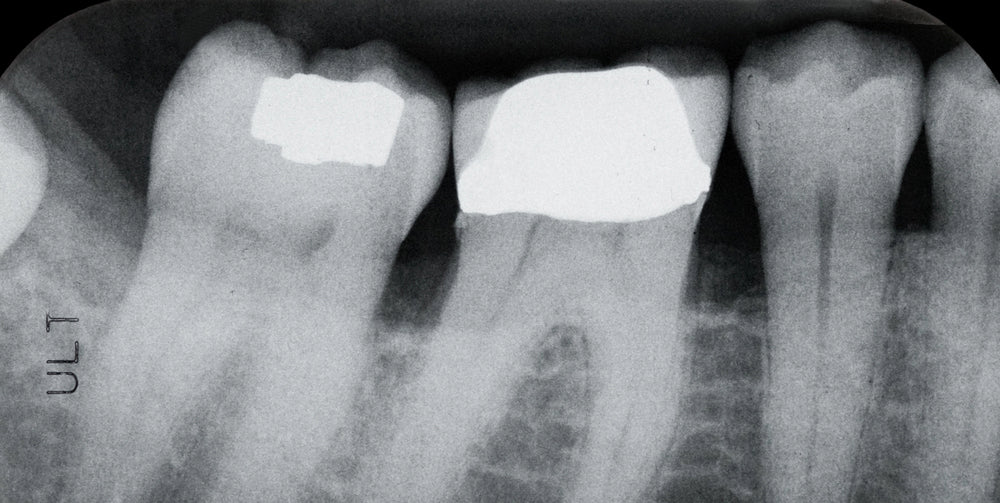 sensitive teeth