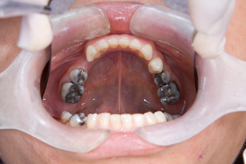 mouth reconstruction
