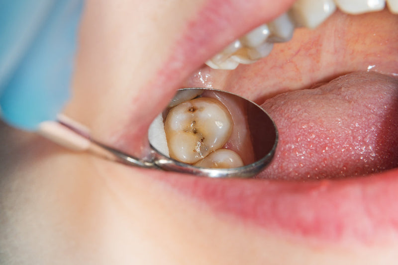 teeth with cavities 