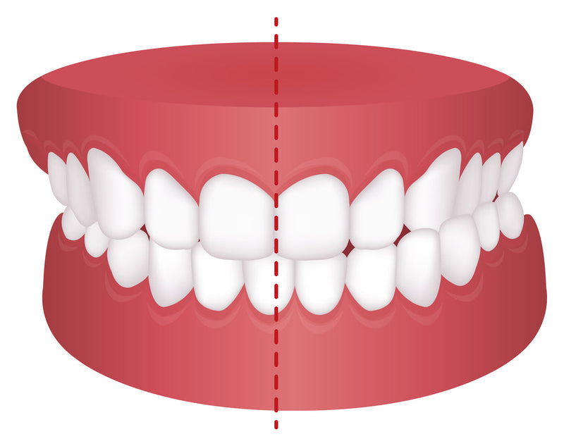 crossbite